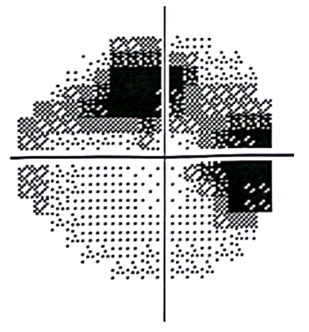 Champ visuel de l’œil droit altéré avec présence d’une atteinte arciforme dans le champ visuel supérieur.