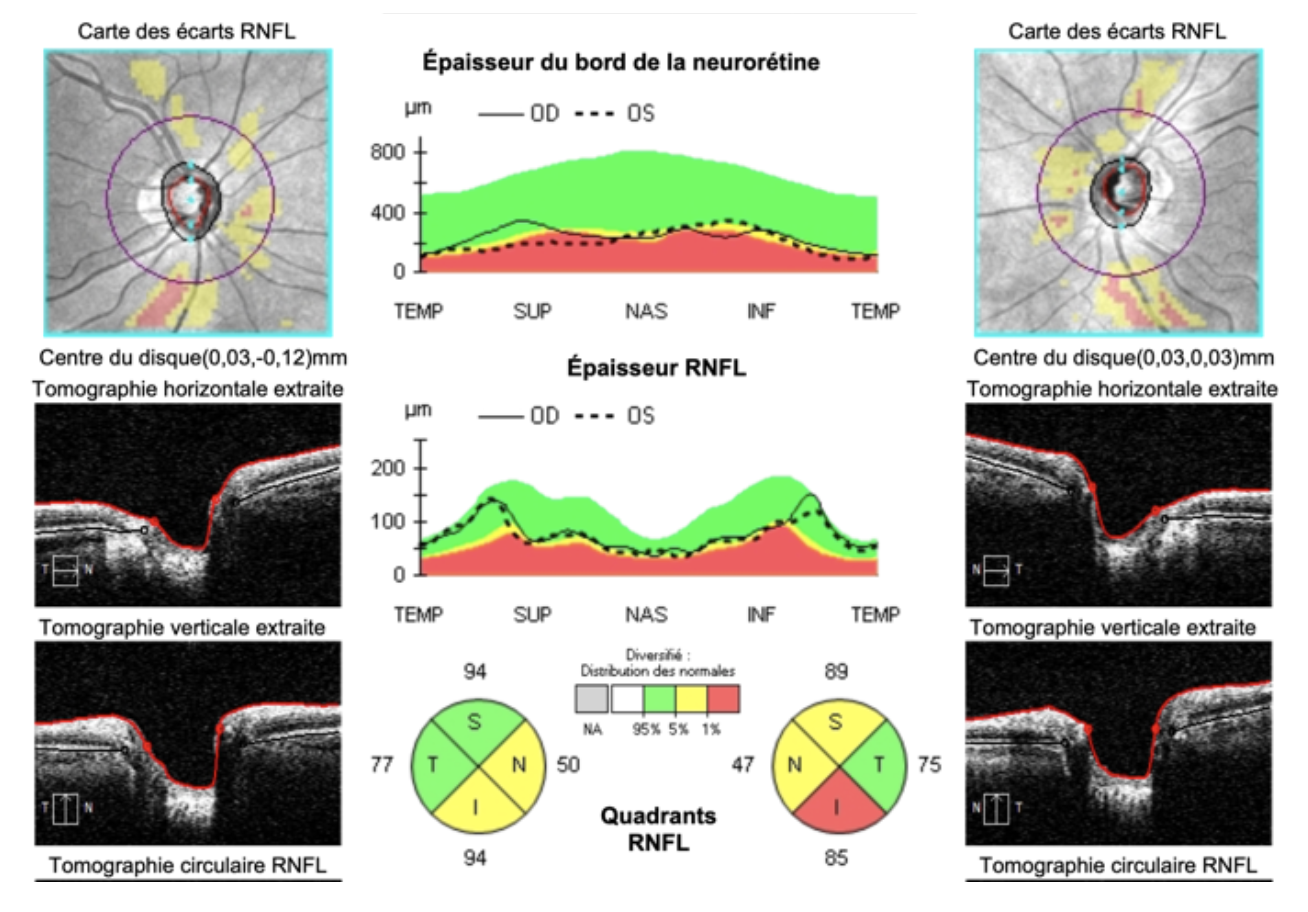 Oct des nerfs optiques des 2 yeux avec cartographie de l’épaisseur des fibres nerveuses par quadrant.